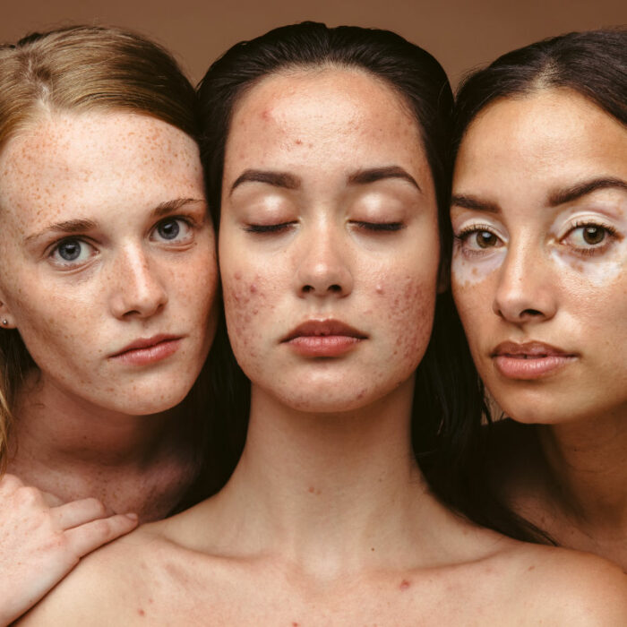 Woman having skin problems content. Close up of three women with unique conditions against brown background.