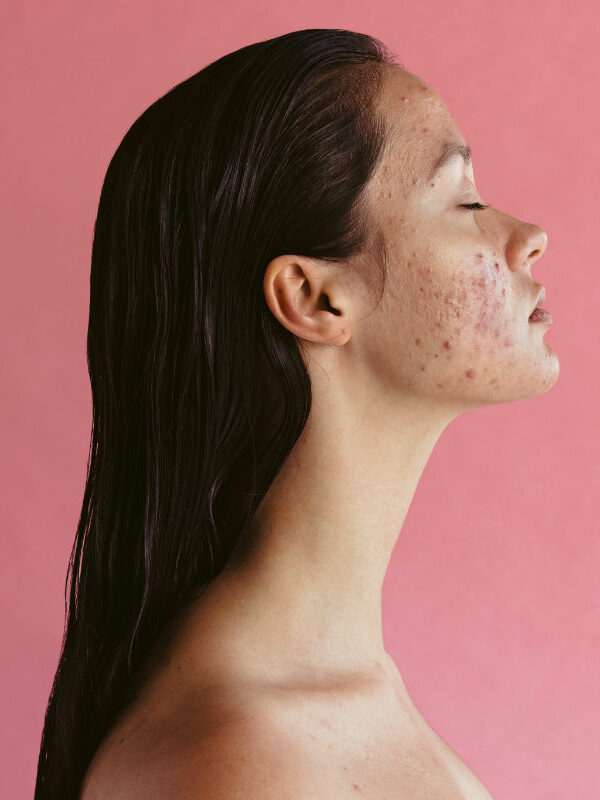 Side view portrait of woman with acne inflammation on pink background. Skin disorders lead to depression and insecurities in women.